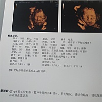 怎么感觉鼻子那么大，张那么丑😂️