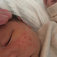 看着宝宝脸上长这个心里难受啊！用金银花水洗了也没多大用。