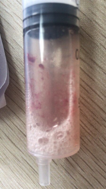 洗胃出来的东西