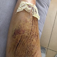 孕29周擦伤了小腿，休息了10天才这个样子，每天消毒，对孩子有影响吗？