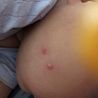 有没有宝马知道这是什么的，全身只有两个，宝宝也不抓，影不影响打预防针