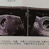 有没有会看男女的宝妈呀？ 8周＋2拍的B超
