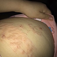 产后腰两侧的妊娠纹变成这样疙疙瘩瘩的而且奇痒无比，抓破了就这样了，有什么办法可以改善？？？