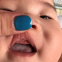 孩子嘴皮上起这样的白点是怎么回事啊 上次啊嘴皮都有 牙龈上也有几个