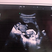 16周➕啦😘孕吐反应已经慢慢没有啦 饿的快 😂有没有会看男宝还是女宝的呀☺️