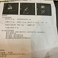 孕13周胎心率161正常吗