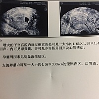 前天查出偏左侧宫角，医生说的很吓人，不建议要，可是我不想放弃啊，不知道现在怎么办，真的难受😣第...
