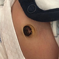 二十几天了，脐带还没掉，也不敢碰，因为中间出过两次血！我该怎么办