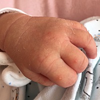 求助，宝宝10天手指头上长泡泡怎么回事啊？