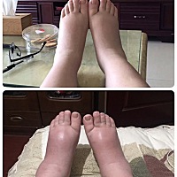 孕期超级水肿 生了后水肿消了 但是皮肤比我妈妈的看到还要老 有没有给我一样情况的恢复得好的宝妈 ...