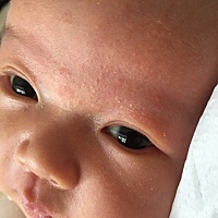 宝宝一个月，眉间眼皮上长了癣一样。脸上都是小痘痘。抱去医院看，医生说没事，用温水多洗洗，但是...