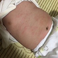 宝宝这个是过敏了还是湿疹的情况
