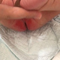 宝宝有黄疸现在好多了！但是因为拉的多屁股腌了！都烂了流油！红红的像猴屁股一样！每次一拉宝宝都疼的...