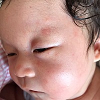 有哪位宝妈知道我闺女脸上起的这是什么疹子，下午有时候还减轻点没这么红，上午就很严重