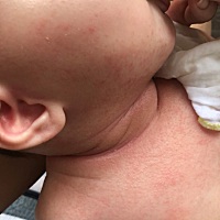 长痱子咋整？急急急。