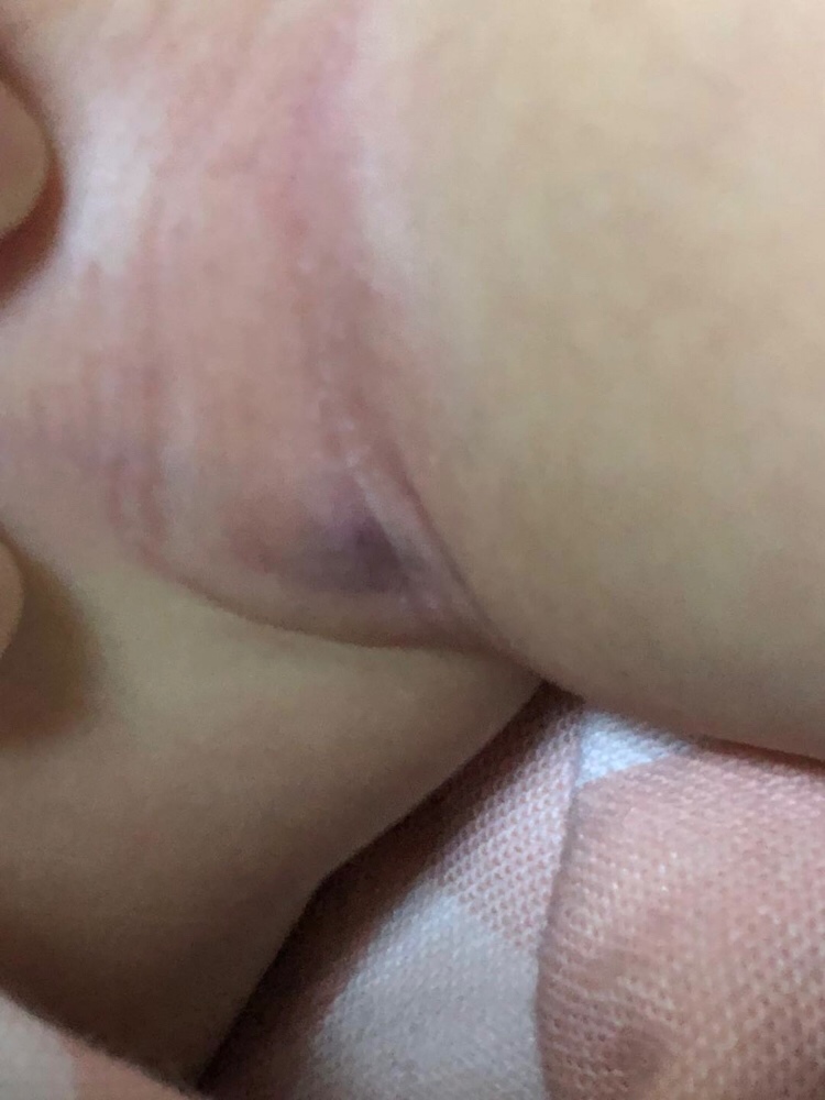 宝宝腋下淹了，紫色的地方有小疙瘩，医生说没事，各位宝妈有类似的情况吗