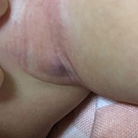 宝宝腋下淹了，紫色的地方有小疙瘩，医生说没事，各位宝妈有类似的情况吗