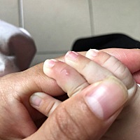 有哪位宝妈知道这是什么？宝宝手上起水泡有点担心
