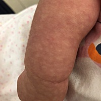 宝宝的手面和小臂都有像五花肉一样的花纹  有没有这样子的  是什么情况