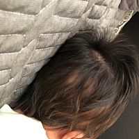 宝宝的头发有一片是黄的  发根也是  有没有知道的宝妈٩😩ི۶٩😩ི۶