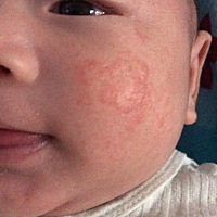 宝马们，我家宝宝起湿疹。你们有没有用过好用的药给我推荐一下。