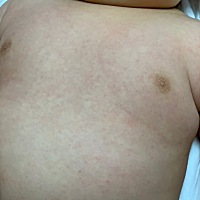 各位宝妈，宝宝这几天脸上身上都有红红的小痱子，该怎么办呢？