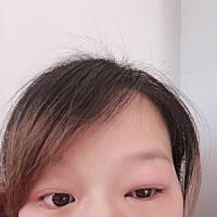 怀孕六个月得了结膜炎，有什么眼药水可以用的？红霉素眼膏用了，生理盐水也洗了，现在越肿越大了！