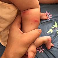 九个月宝宝被蚊子叮咬后红肿大家有什么好的办法吗