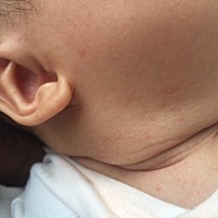 宝宝脖子长满了这些，是痱子吗？该怎么办呢，求助