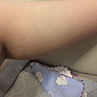 怀时不觉的，生了才发现到处都是妊娠纹，肚子，大腿，屁股，胯，胸，连小腿也……