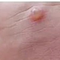 这是什么原因，各位，类似于这种得水泡