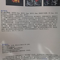 今天照三维，照了两次，宝宝不配合一直不翻身，照出来结果说胎儿双肾盂分离和右位主动脉弓！心里有点不...