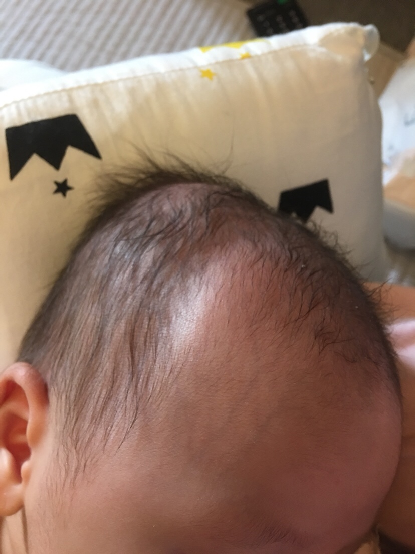 新生儿21天，发现宝宝右侧头部这样，请问有宝妈知道为什么吗？麻烦有经验的宝妈帮忙解答一下，谢谢🙏🙏🙏🙏🙏