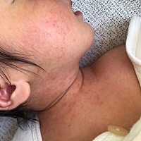 不知道宝宝这是长什么了，宝妈们有什么好的药和方法吗？