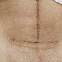 双胞胎剖宫产的刀口，伤口不是很长，横切的，昨天拍的刚刚手术后第10天，恢复得很好，感恩～