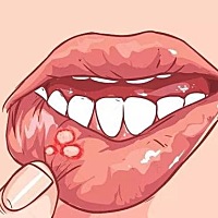 女性经期容易口腔溃疡！为什么 中医认为这种口腔溃疡病因较复杂，与自身免疫机能低下、内分泌功能紊乱、...