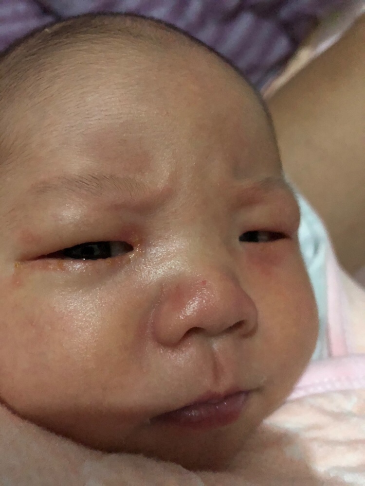 宝宝眼睛周围红红的，是怎么回事，好几天这样了，好心疼😔 有知道的宝妈吗？