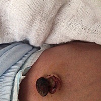 宝宝肚脐脱落成这个样子是正常的嘛？求助