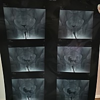 去年12月宫外孕切除右侧输卵管，今年5月份做了左侧造影，谁能帮我看下我的输卵管情况？