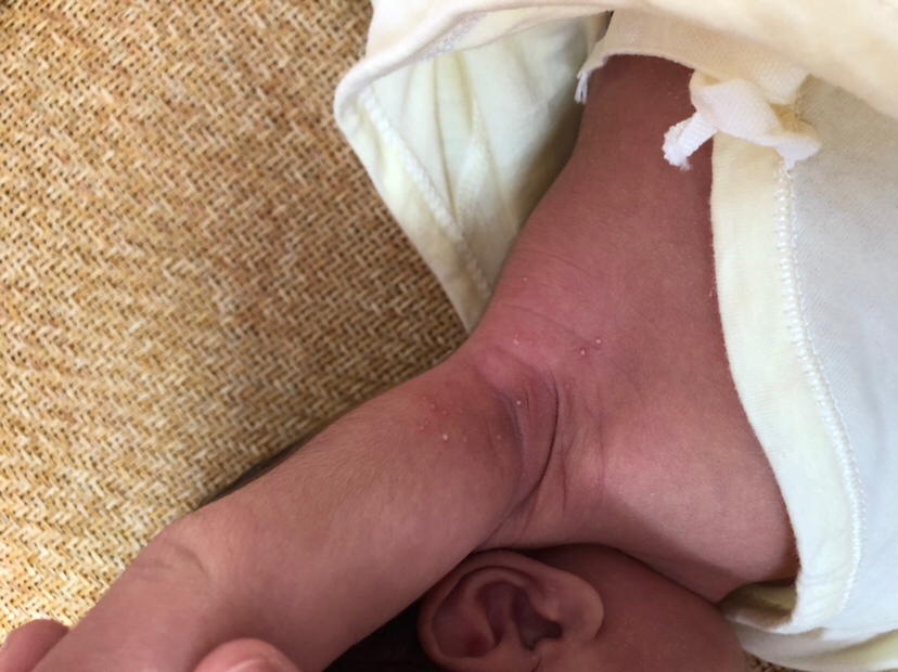 有谁知道孩子出生才出生一个星期，长的这个是什么东西