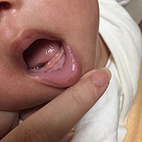 请问宝妈们知道这长的是什么，摸起来有点硬，宝宝才一个多月、长牙不可能这么早吧