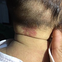 47天的宝宝后脑勺长了块红斑  平平的  有宝妈知道是什么嘛？在线等   谢谢了！！