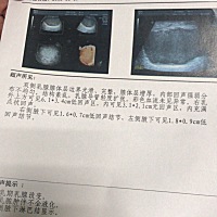 哺乳期2月 急性乳腺炎 有脓肿 硬块 要穿刺 有跟我一样的吗 怎么治疗的大家