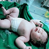 6月19剖腹产，9.1斤男宝，帆状胎盘+悬垂腹还好选择剖腹产，第一天伤口换纱布 医生的尖✂剪刀在伤口...