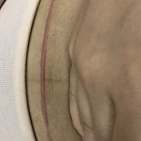 刨腹产疤痕增生会好吗