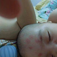 有没有宝妈知道脸上这一圈圈的是 什么呀？