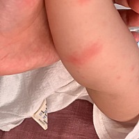 宝宝被蚊虫叮咬，包包一直不消，用什么牌子的药膏或者产品好一点？！