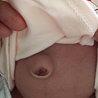 宝宝肚脐凸出来好大啊，一哭就更大，这是怎么回事儿，后期能不能凹下去