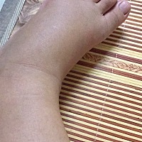 水肿，鞋子都不知道换了多少双😂