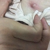 胸下面起个硬疙瘩，红红的，好多天了，是疮吗？谁能帮我看看